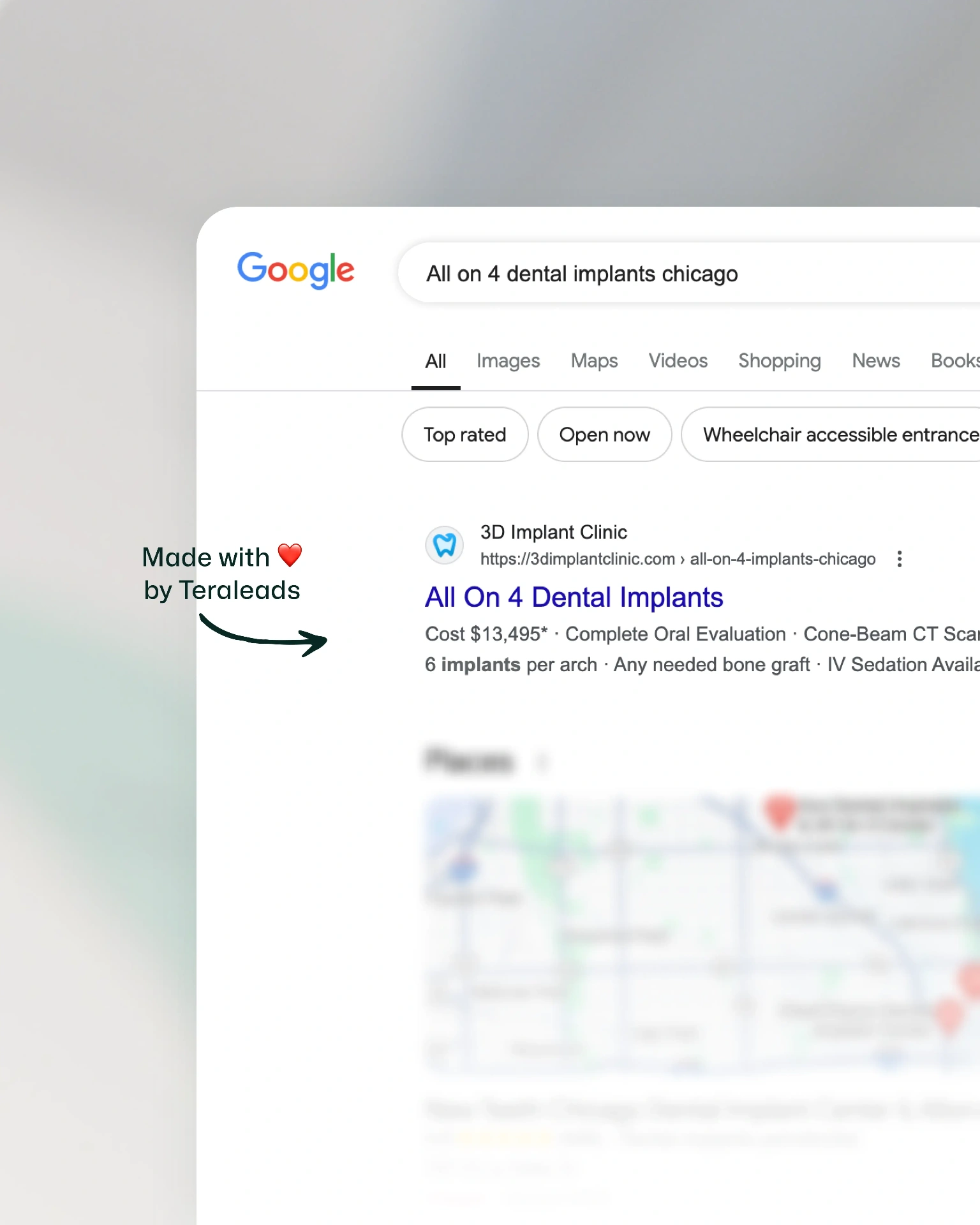 Patient searches for implants